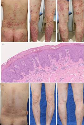 Successful treatment of psoriasis vulgaris with ixekizumab in a patient with concurrent Sjögren’s syndrome presenting with dry eye and incomplete SLE